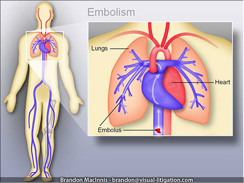Medical Malpractice Trial Graphic - Embolism, heart and lungs.