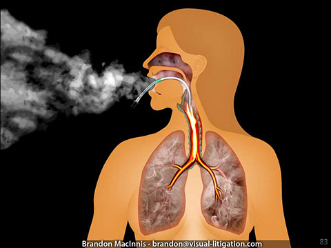 Medical malpractice illustration showing airway fire in lungs and respiratory system.